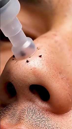 “Huge Blackheads Popping! Deep Extraction Session"