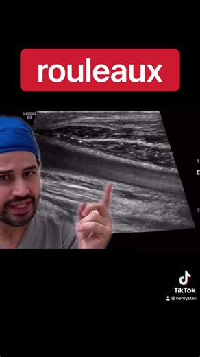 Rouleaux Flow.. Slow flow and stacking of red blood cells can give an “auto contrast” appearance to blood flow.