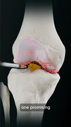 Platelet rich plasma treatment for knee arthritis