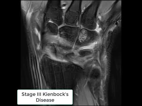 Stage III Kienbock's Disease