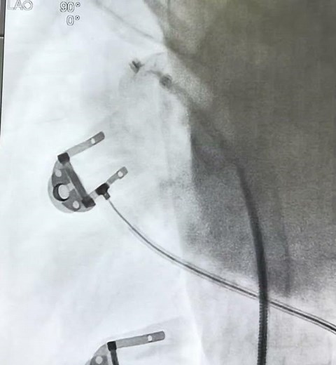 PDA Device closure via aortic side