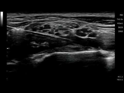 Supraclavicular brachial plexus block ( with post-block scan )