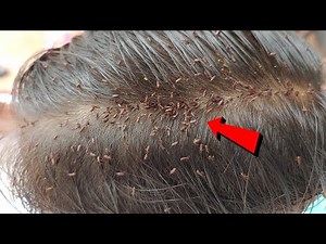 This boy have beautiful hair but full of giant lice Lice Removal
