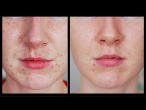 Freckles Be Gone! - My Laser Experience