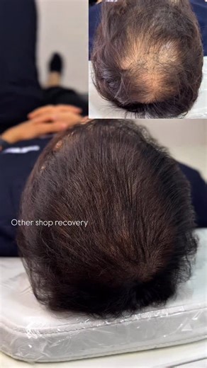 The video shows the results after 2 full sessions for the overall crown. The work isn’t fully completed yet, but this explains why SMP always requires at least 2 sessions. This client flew in and out of Singapore twice just to receive SMP with us we truly appreciate his dedication and trust. He also had a past hair transplant and previous SMP done elsewhere. Post #hairtransplant scalps are very different from normal skin, so for all post-transplant clients we always do a test session first to pl