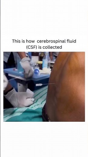 This is how cerebrospinal fluid csf is collected #viral #explore #biology #trending