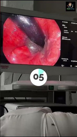 Sigmoidoscopy #shorts #medical # medschool
