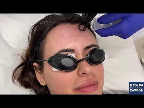 Erbium Laser Resurfacing Treatment