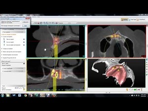 Simplant treatment planning
