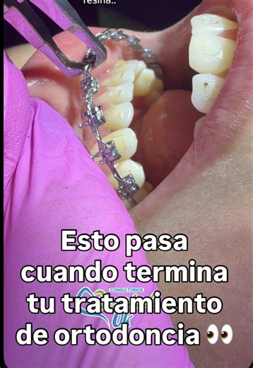 Proceso de Retirar Brackets: Paso a Paso y la Importancia de los Retenedores