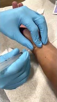 Ganglion Cyst Drainage at Plum Health DPC in Detroit