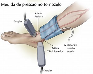 Índice Tornozelo-Braço