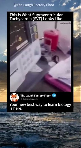 🫀This is what 📈 supraventricular tachycardia SVT⚡ looks 🔌 | MDCT