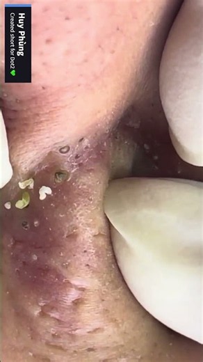 Corner of that NOSE!😮 #blackheads #pimplepopping #satisfying #shortsfeed #viralvideos