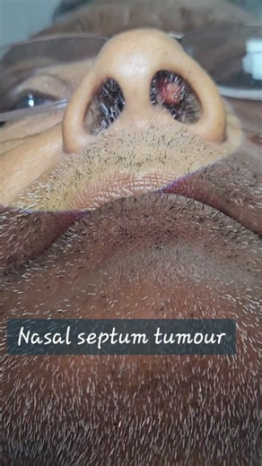 Dr Baisali Sarkar on Instagram: "Nasal septum tumors are rare, heterogeneous growths, ranging from benign (e.g., lobular capillary hemangioma) to malignant (e.g., squamous cell carcinoma). They often present with unilateral nasal obstruction, persistent nosebleeds, and, if malignant, facial pain. Diagnosis usually involves CT/MRI scans and tissue biopsy. Treatment depends on the underlying cause. Visit Nearby ENT doctor for further management."