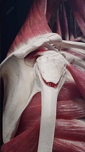 Greater Tuberosity Fracture — visualised by VOKA