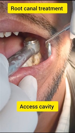 Root canal treatment 😍 access cavity 😍 #shorts