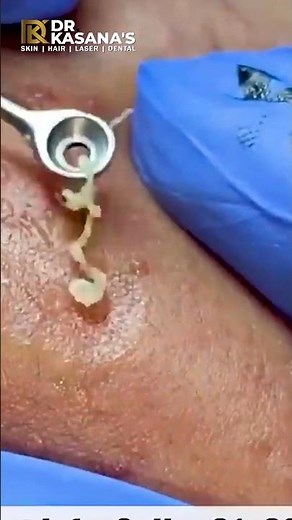 BLACKHEADS REMOVAL By Dr. Lalit Kasana's