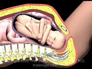 Shoulder Dystocia Anterior Fetal Shoulder Animation by Cal Shipley, M.D.