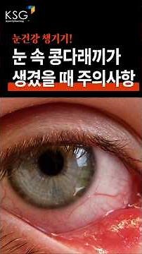 눈 속 콩다래끼가 생겼을 때 주의사항