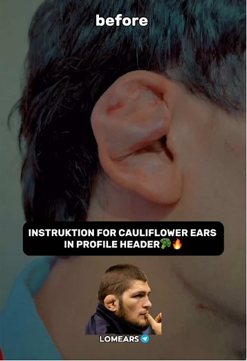 Instruktion for cauliflower ears in profile header🥦✅#howcauliflowerears #tutorialcauliflowerears #cauliflowerear #wrestling #fyp #germany #france🇫🇷 #europewrestling #khabib_nurmagomedov #oreille
