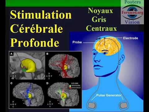Stimulation Cerebrale Profonde: maladie de parkinson, tremblements