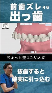 出っ歯、口ゴボや八重歯をホワイトワイヤー矯正で安い費用50万円〜鈴木歯科医院 埼玉県さいたま市大宮駅5分 矯正歯科医院 マウスピース矯正 茨城県東京千葉からも受付
