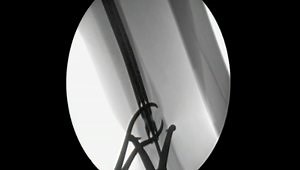 Intramedullary Nailing of Distal Tibial Fracture