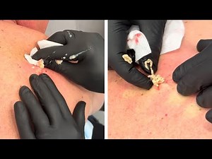 EXPLOSIVE BACK CYST!