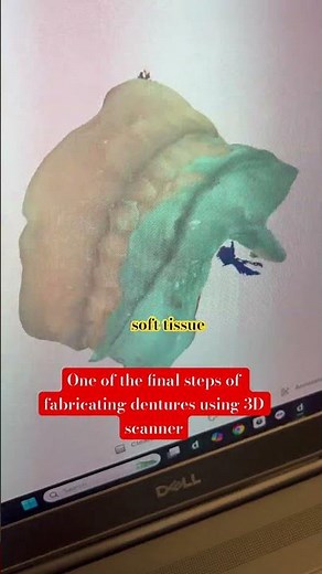 Making Dentures by Digital Impression With 3D Scanner |Dandy Lab |3Shape Scanner#digitalsmiledesign