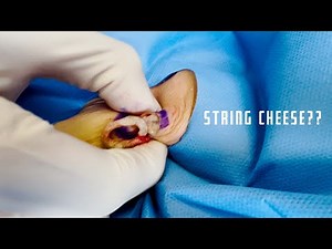 String Cheese or Cyst? | CONTOUR DERMATOLOGY