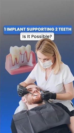 Can One Dental Implant Support Two Teeth? Expert Dentist Explains!