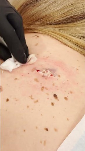 LARGE BACK CYST!