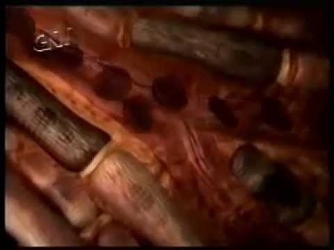 Infarto Agudo do Miocardio - Parte 1