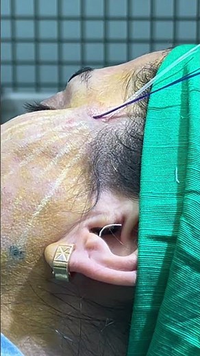 Thread Lift Procedure