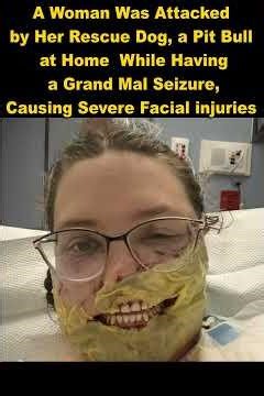 Woman attacked by rescue Pit bull during grand mal seizure at home, suffers severe facial injuries