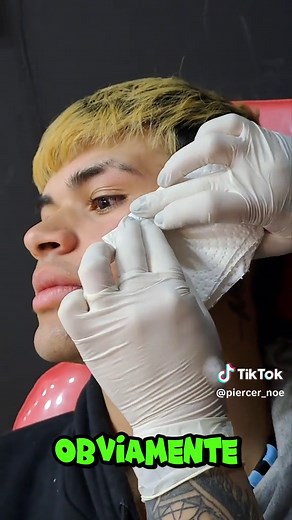 Colocación de Microdermal en Pómulo: Proceso Detallado