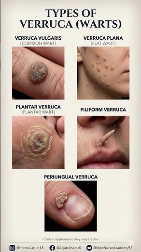 Types of Warts (Verruca) Explained Clearly | Clinical Identification for Exams