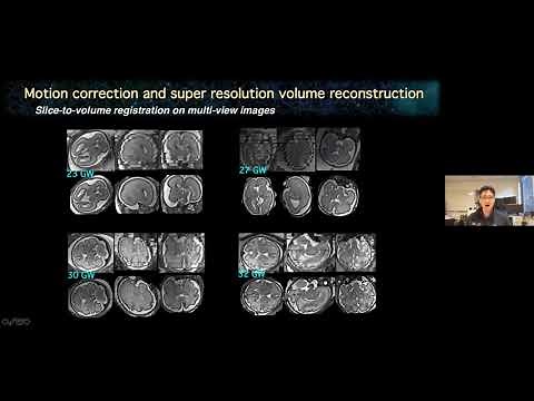 Advanced fetal brain MRI processing and analysis: Methods and Applications