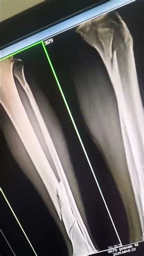X RAY LEFT LEG AP LAT VIEW #xray #duet #viral #hospital #doctor #mahibhai