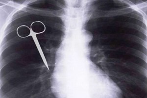 Retained Surgical Items: An overview of the other side of the surgical room