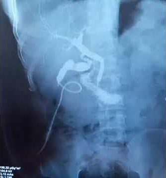 Intra-operative cholangiogram