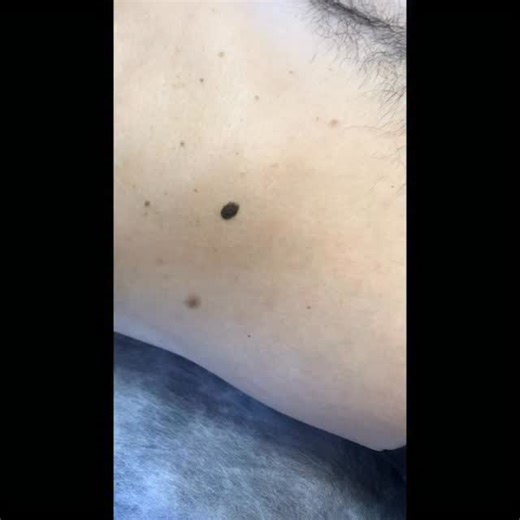 Dermoscopy - Skin cancer | Not every ‘ugly duckling’ is malignant, it can just be a seborrheic keratosis. Courtesy of colleague @carlademarque.dermato Pictures:... | Instagram