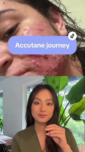 Accutane Journey: Mild Acne Before and After 1 Month