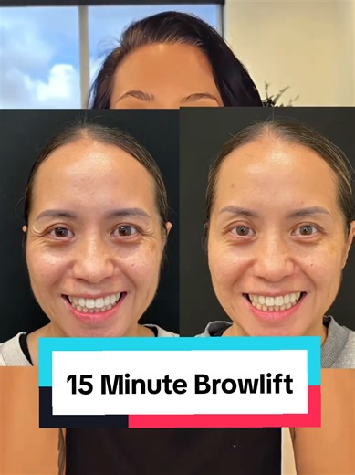 Brow anatomy neuromodulators explained. #browlift #aestheticseducation #learnontiktok #beautyscience #fyp
