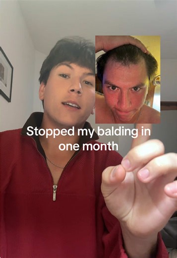 Stop Balding Naturally in One Month