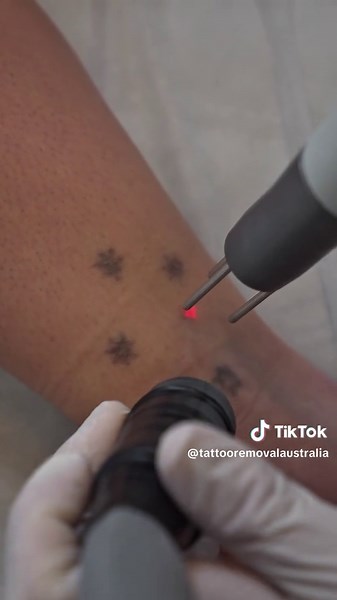 Tattoo Removal Brisbane on TikTok