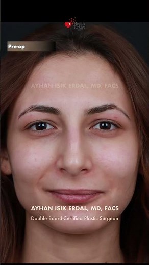 Closed Rhinoplasty | Before & 4 Months Post-Op