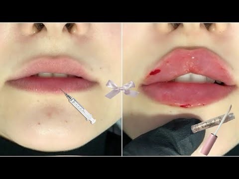 EXTREME LIP PLUMPER ⚠️ big + pink + juicy lips (subliminal)