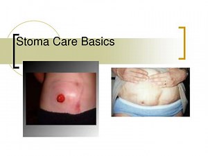 Stoma Care Basics - SlideServe
